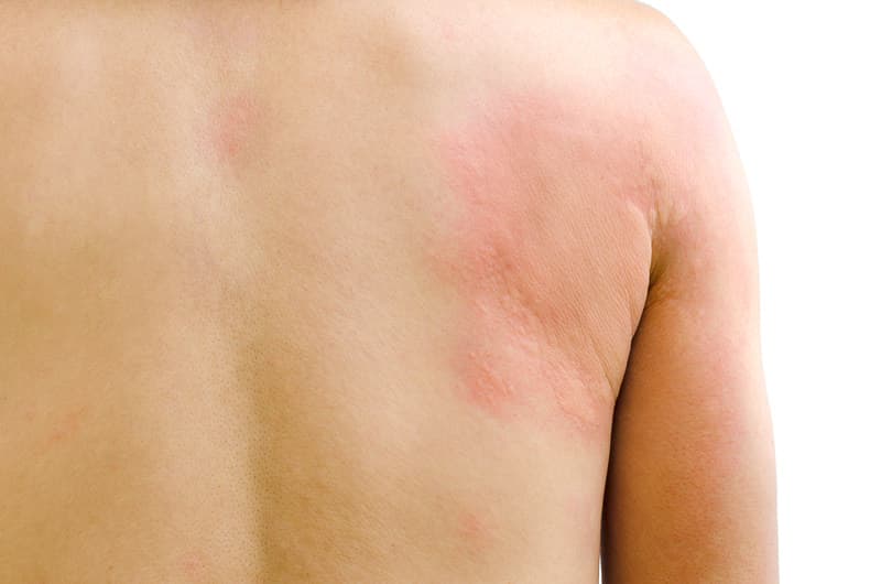 Hives or urticaria in children & teenagers